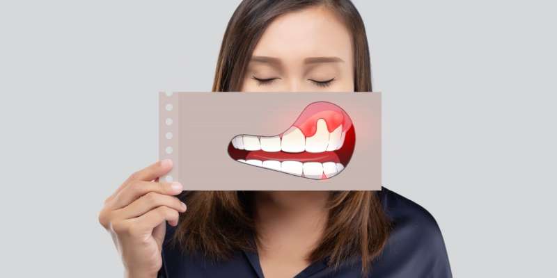 Periodontitis Nedir? Gingivit ve Periodontal Hastalıklar