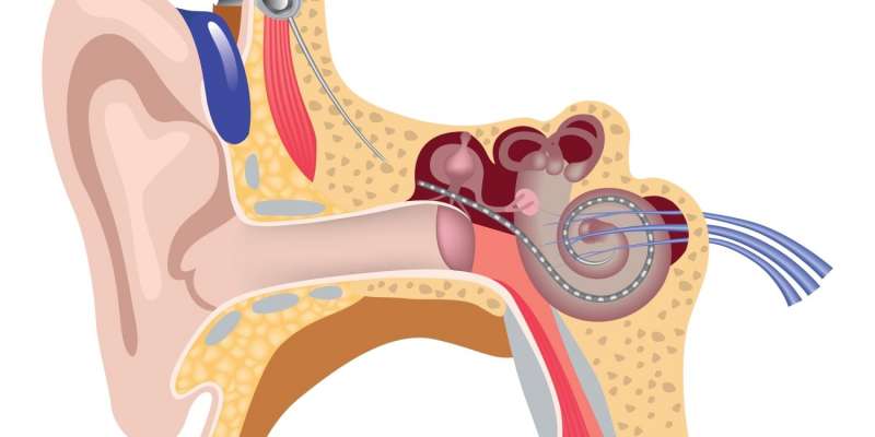 Koklear İmplant (Biyonik Kulak) Nedir ve Nasıl Çalışır?